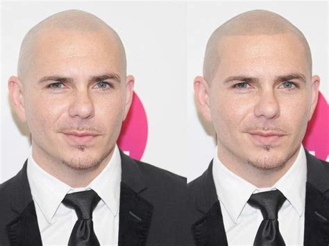 scalp micropigmentation regret|celebrities with scalp micropigmentation.